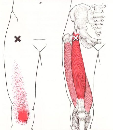 大腿直筋付着部の痛み