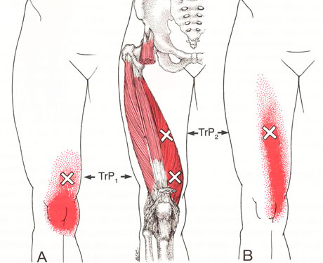 膝の痛みのトリガーポイント